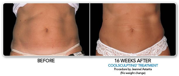 Coolsculpting Abdomen at Sculpted Contours