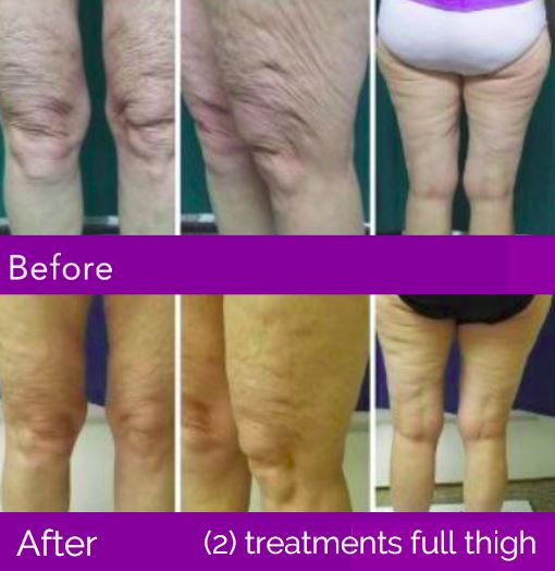 TruSculpt Treatment Results on Legs in Buckhead, Atlanta, GA