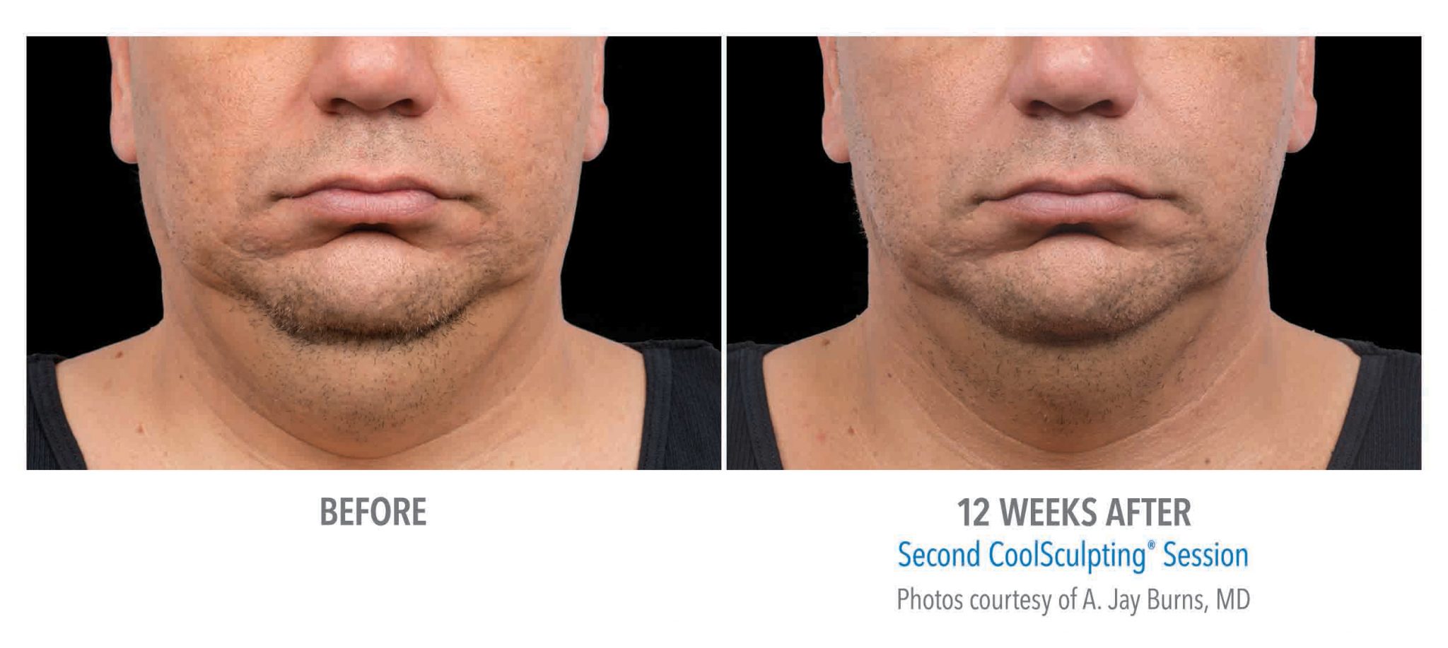 Double Chin Reduction Atlanta CoolSculpting Chin Sculpted Contours