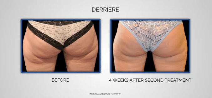 CoolSculpting Derriere Before and After Video - Sculpted Contours - Atlanta, GA