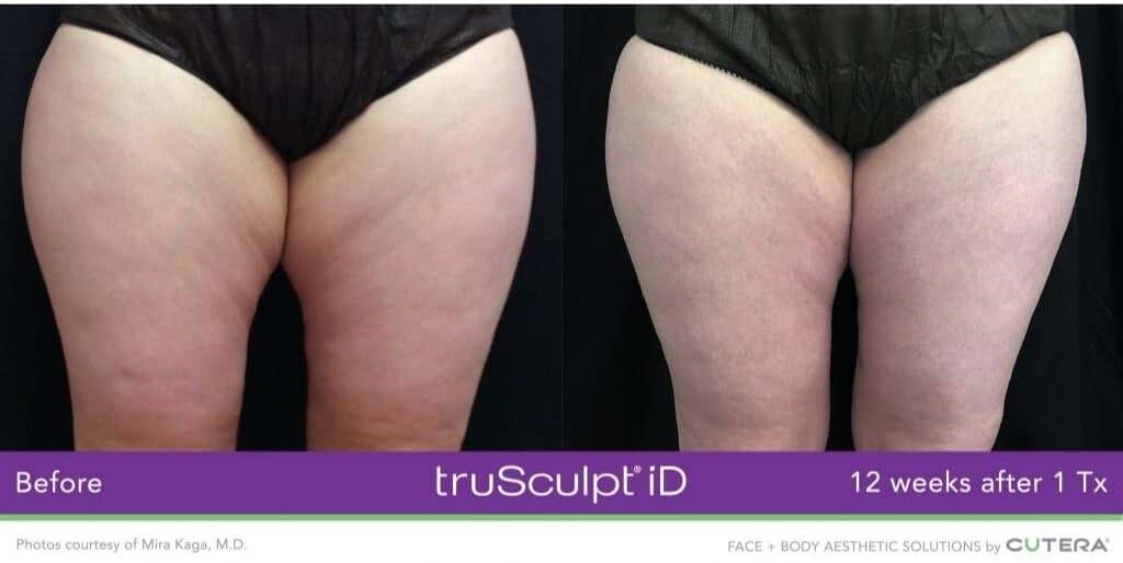 Full Thigh Reduction with TruSculpt iD - Sculpted Contours - Atlanta, GA