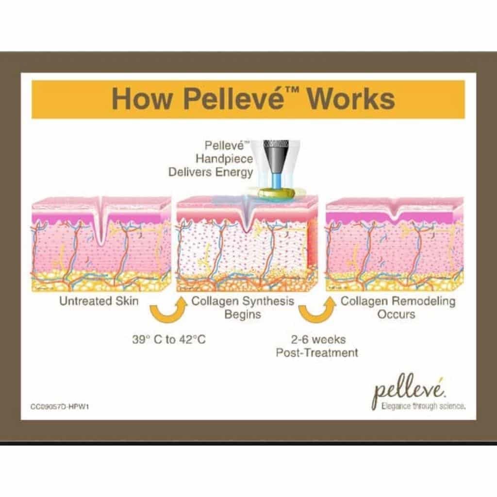 Pelleve and How it Works - Sculpted Contours - Atlanta, GA