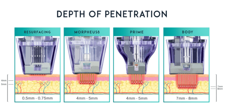 Morpheus RF Microneedling Treatment Depths Sculpted Contours Alpharetta GA