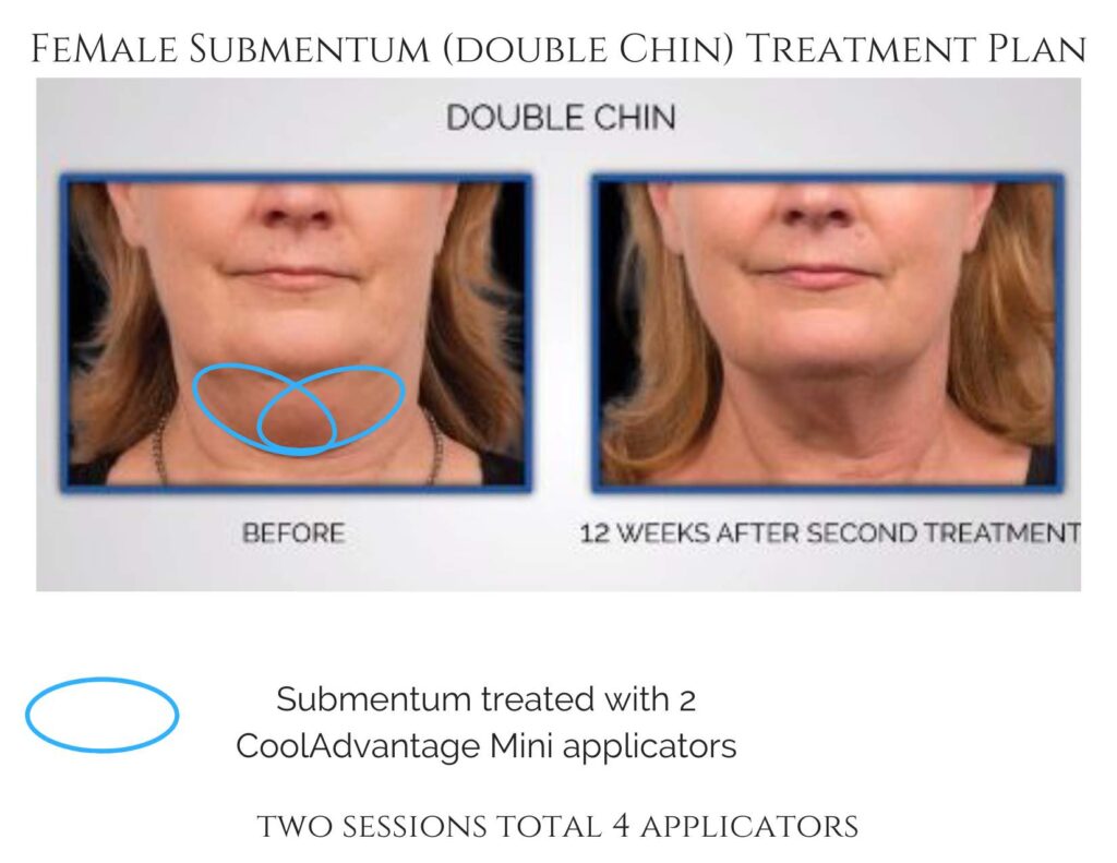 Before and after CoolSculpting results for female double chin, showing fat reduction after two treatment sessions.