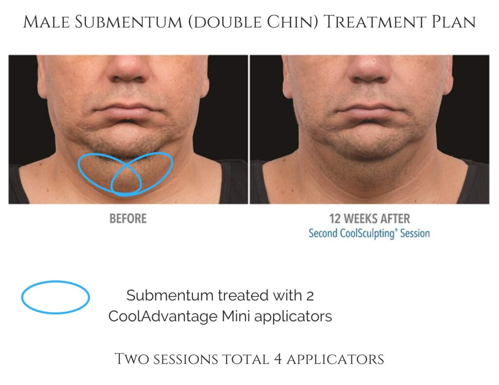 CoolSculpting Double Chin Man