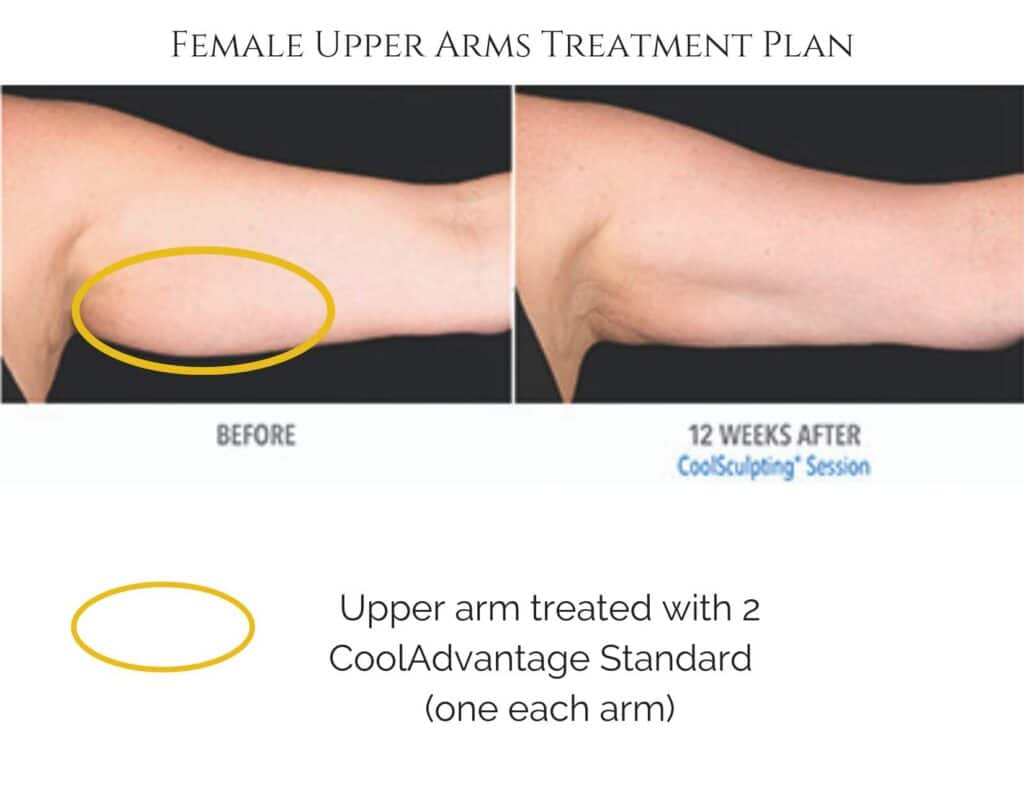 CoolSculpting Price Upper Arms