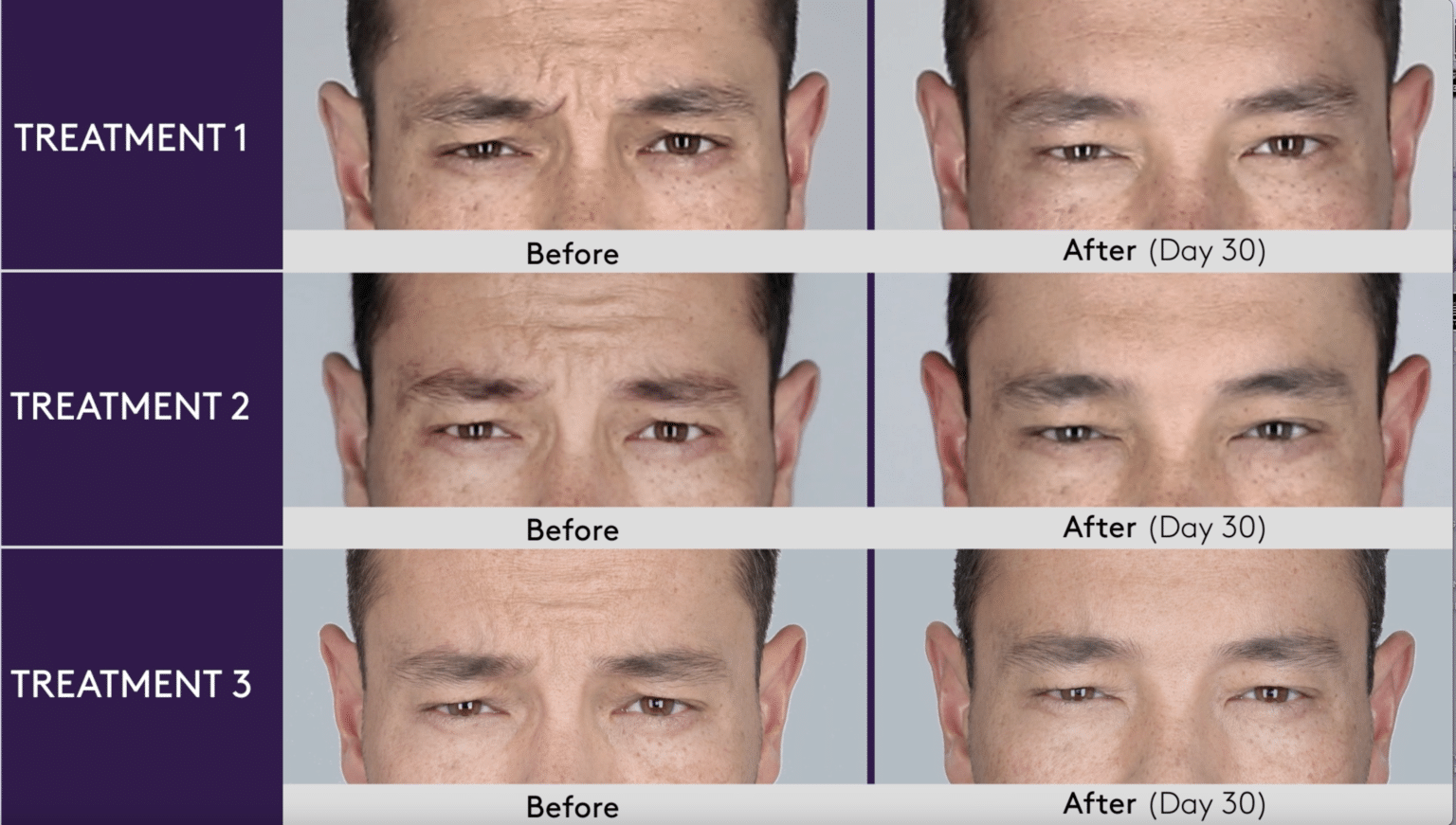 Botox Results on a Man Frown Lines Between Brows