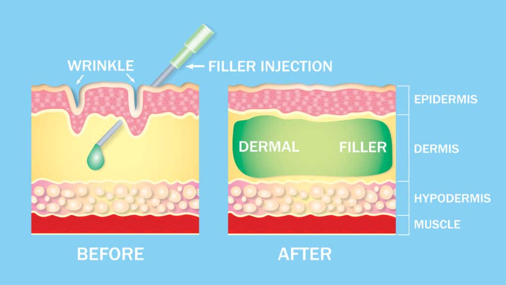 How Dermal Fillers Work