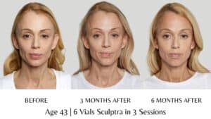 Sculptra Results