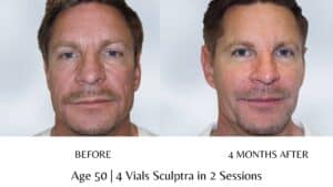 Sculptra Before and After Male Face