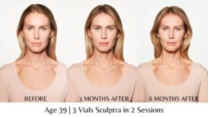 Sculptra Before and After