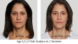 Before and After Sculptra Results