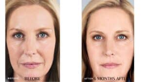 Sculptra Before and After Photos