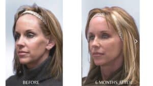 Sculptra Before and After Results