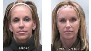 Sculptra Before And After Results
