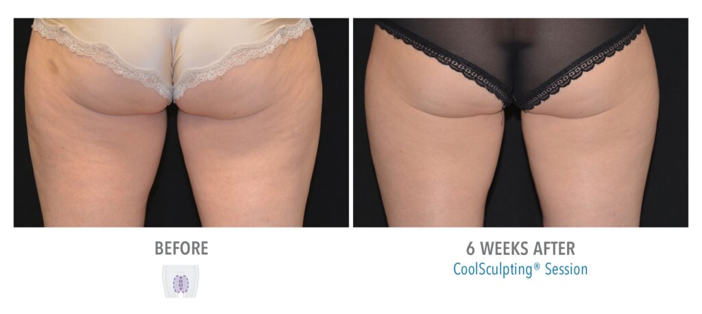 CoolSculpting Inner Thighs Results