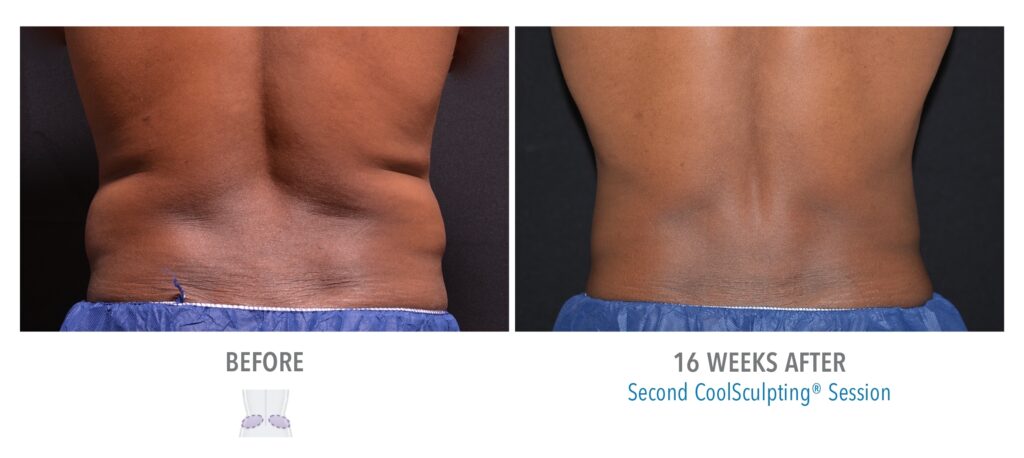 CoolSculpting Male Love Handles Results