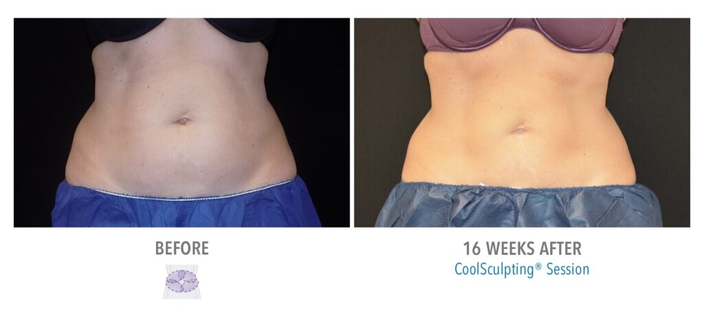 Full Abdomen CoolSculpting Results