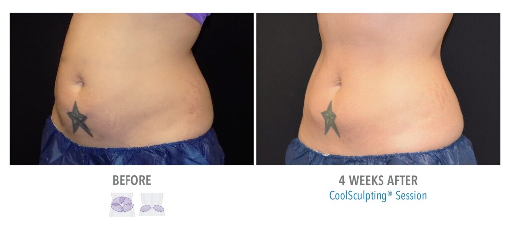 CoolSculpting Results Abdomen and Love Handles