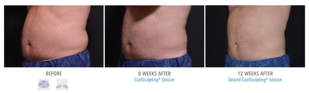 CoolSculpting Results Male Upper and Lower abdomen and Love Handles