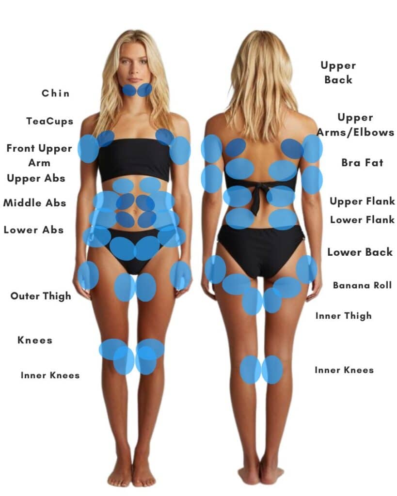 CoolSculpting treatment areas on the body – front and back view highlighting fat reduction zones.