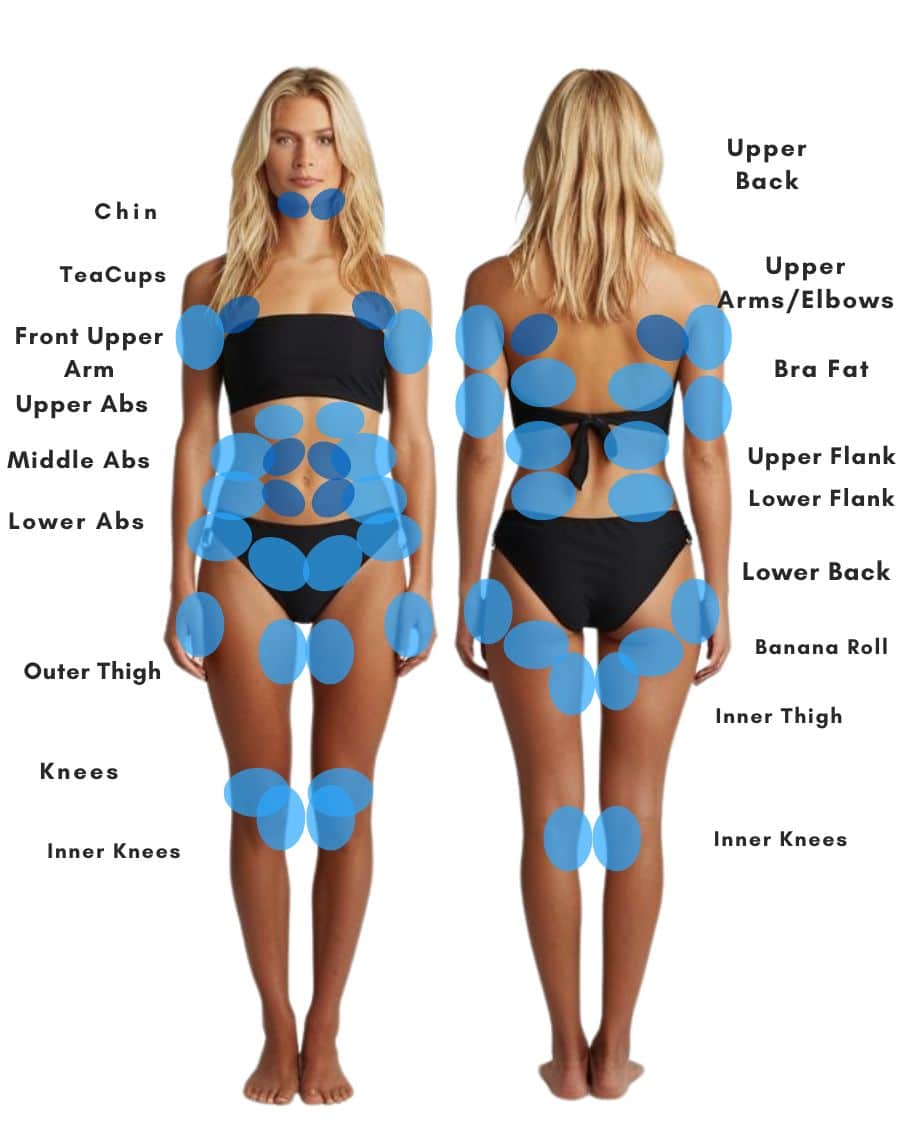 CoolSculpting treatment areas mapped on female body, showing target zones for best results.