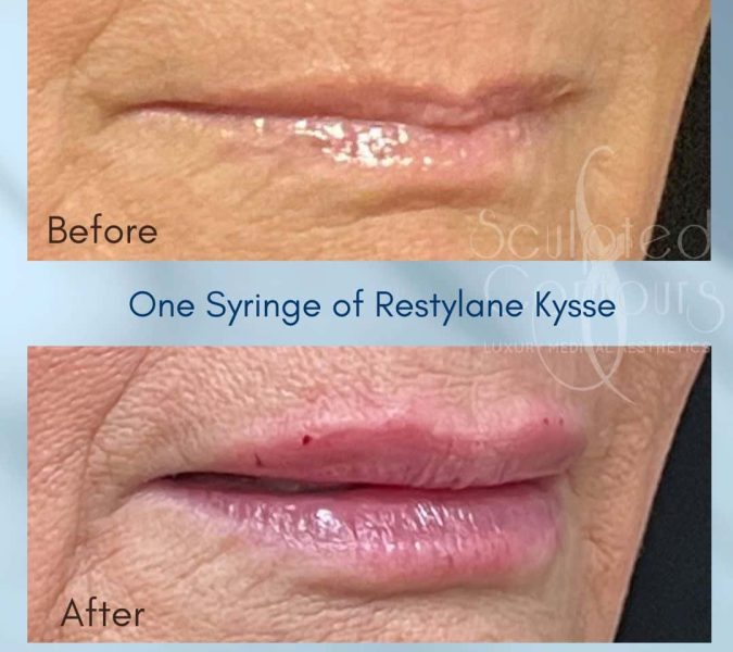 Lip Filler Results Kysse in Alpharetta-Ga-Sculpted Contours