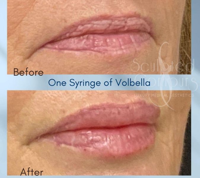 Lip Filler Results-older-women-Sculpted-Contours-Alpharetta-GA